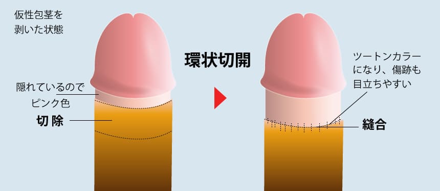 包皮環状切除（メスを入れる）で早漏を改善