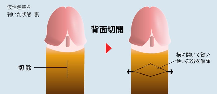 切りすぎを回避する背面切開