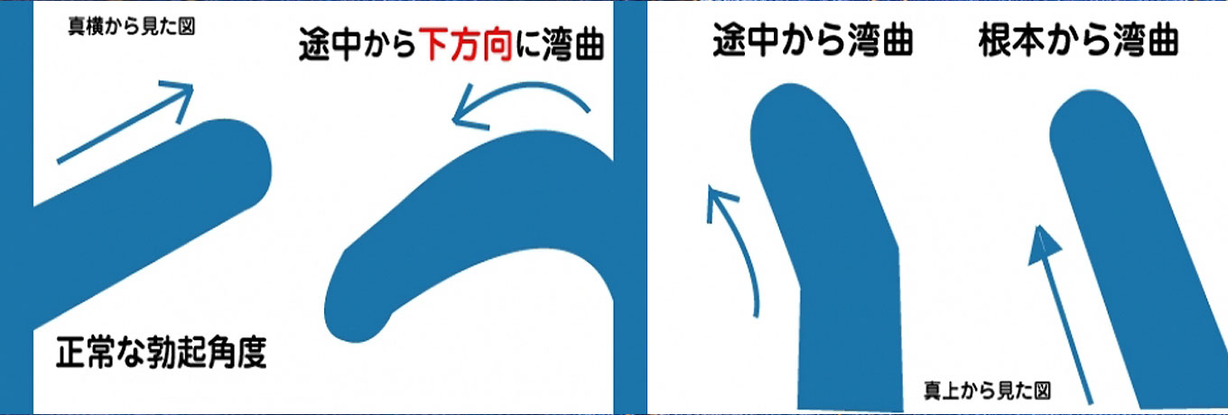 そもそもなぜペニスは湾曲するのか？