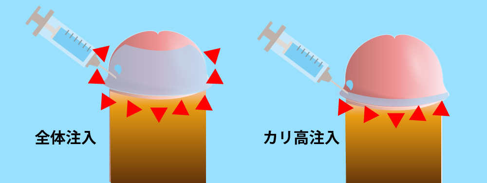 薬剤注入による亀頭増大（カリをデカく）